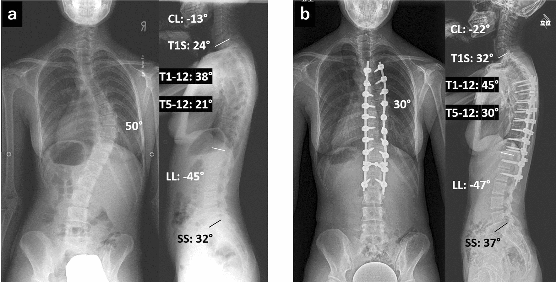 Neck and shoulder pain in thoracic adolescent idiopathic scoliosis 10 years after posterior spinal fusion