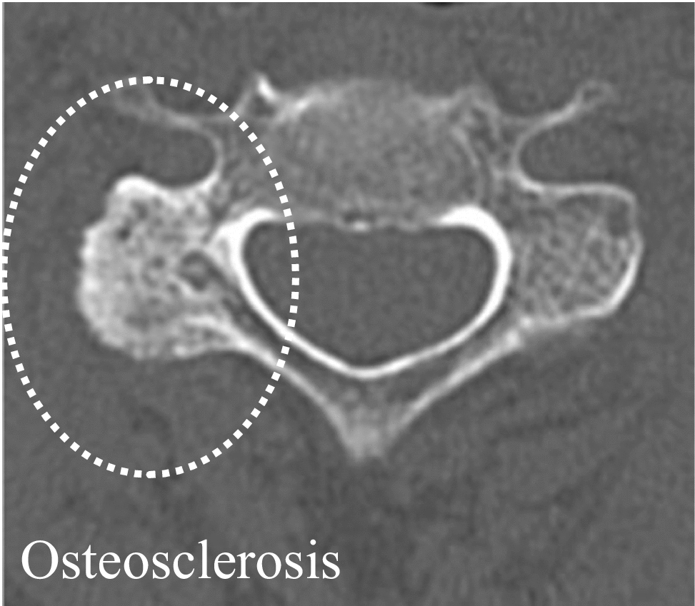 Impact of osteosclerosis on cervical pedicle screw insertion using preoperative CT-based navigation