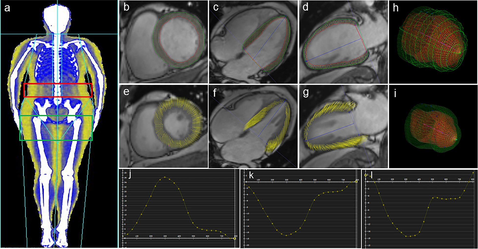 The effect of hyperlipidemia and body fat distribution on subclinical left ventricular function in obesity: a cardiovascular magnetic resonance study