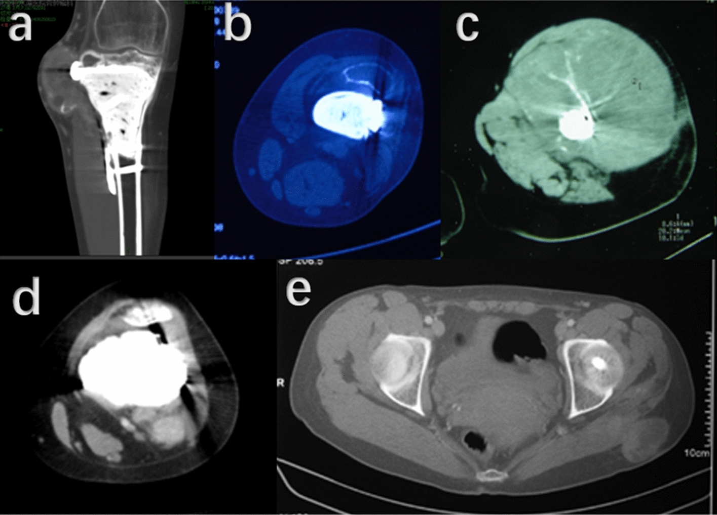 Giant cell tumor of bone at distal radius suffered more soft tissue recurrence and ultrasonography is effective to detect the soft tissue recurrence