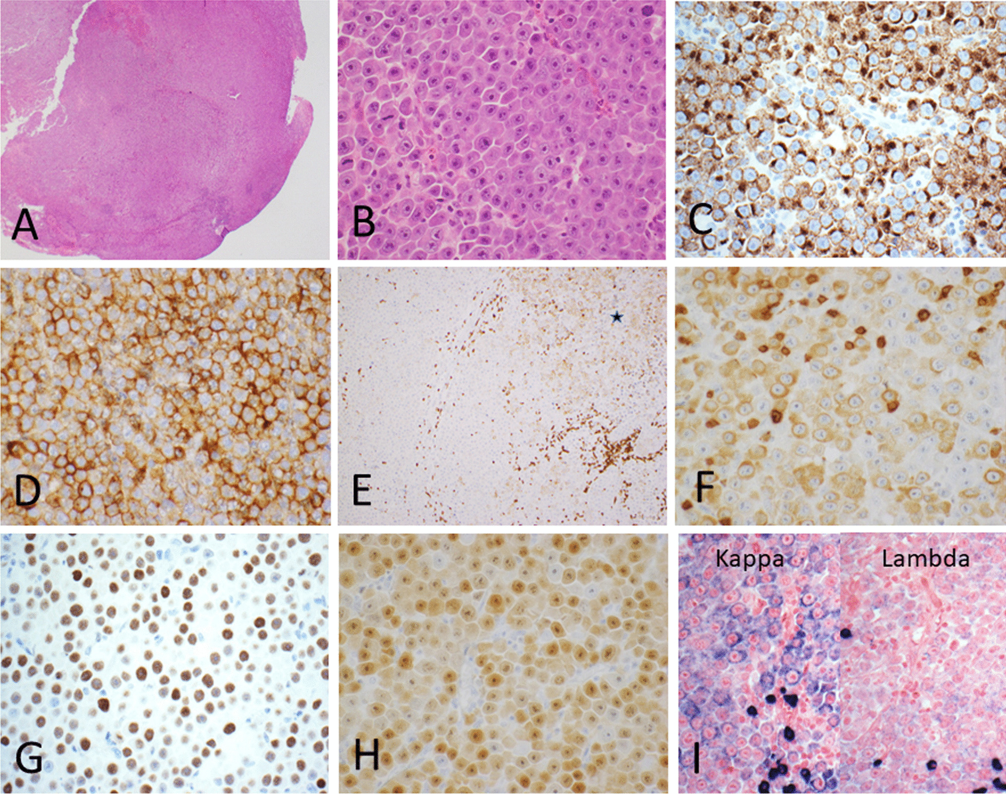 ALK-positive large B-cell lymphoma (ALK + LBCL) with aberrant CD3 expression
