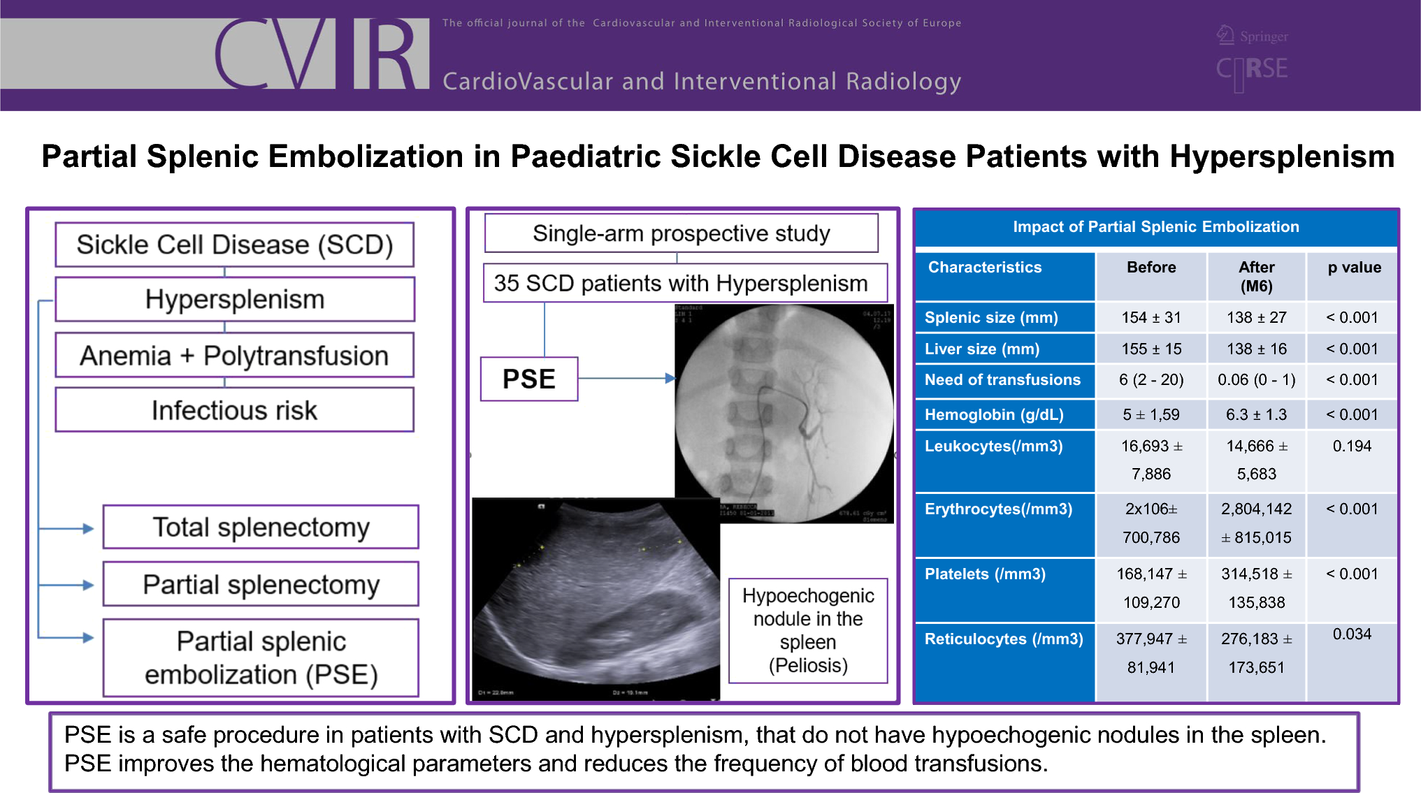 Partial Splenic Embolization in Paediatric Sickle Cell Disease Patients with Hypersplenism