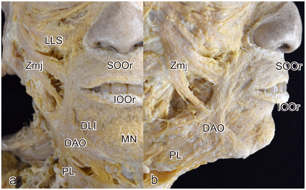 The three layered structure of orbicularis oris and buccinator complex with partial connection at the modiolus and partial direct continuation