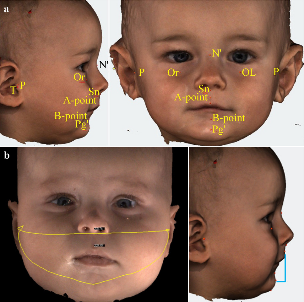 Prospective cohort study on facial profile changes in infants with Robin sequence and healthy controls