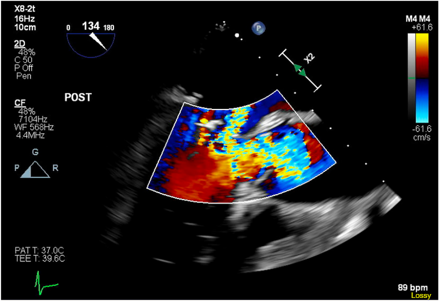 Intraoperative Echocardiography: Guide to Decision-Making