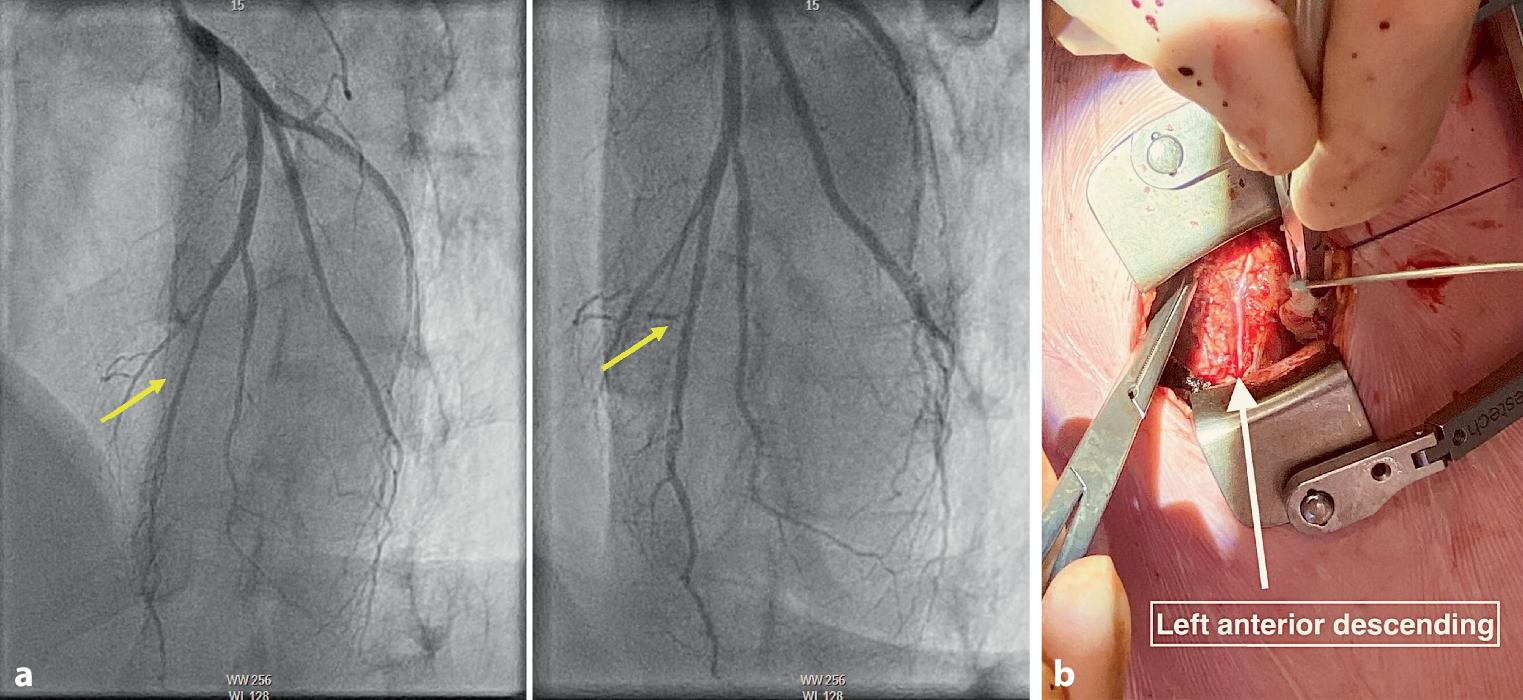 Intramyocardial left anterior descending unroofing using a minimally invasive off-pump approach