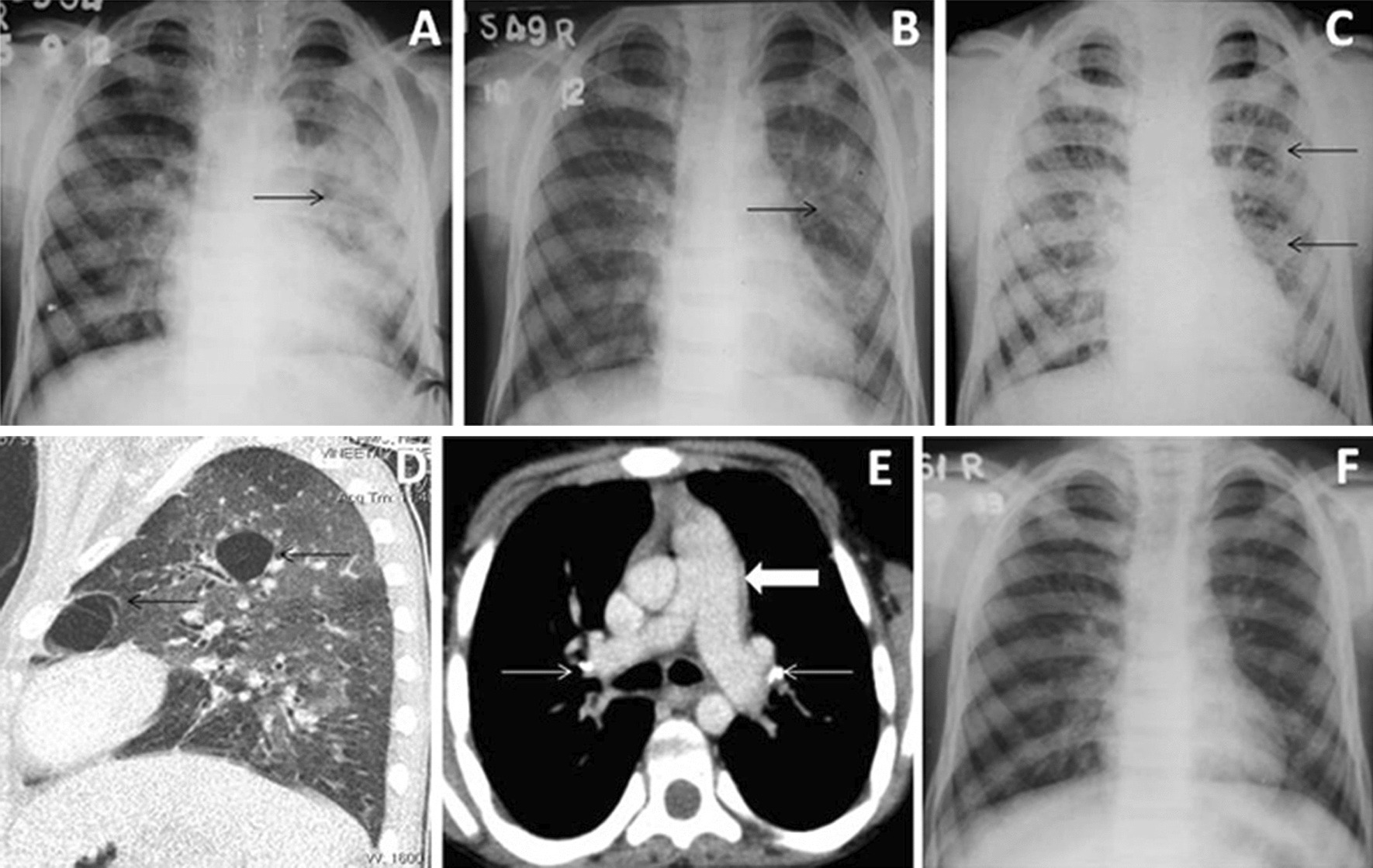Lung infections in HIV-infected children: imaging pattern recognition and its correlation with CD4 counts