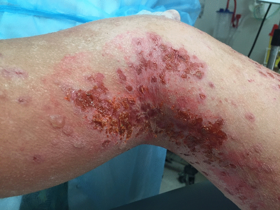 Secondary Bacterial Infections in Patients with Atopic Dermatitis or Other Common Dermatoses