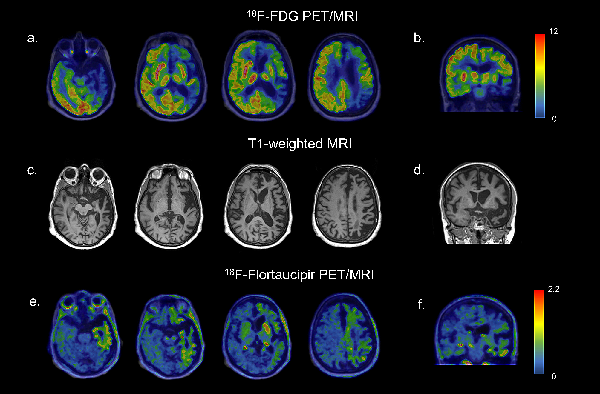 Neuroimaging-guided diagnosis of possible FTLD-FUS pathology: a case report