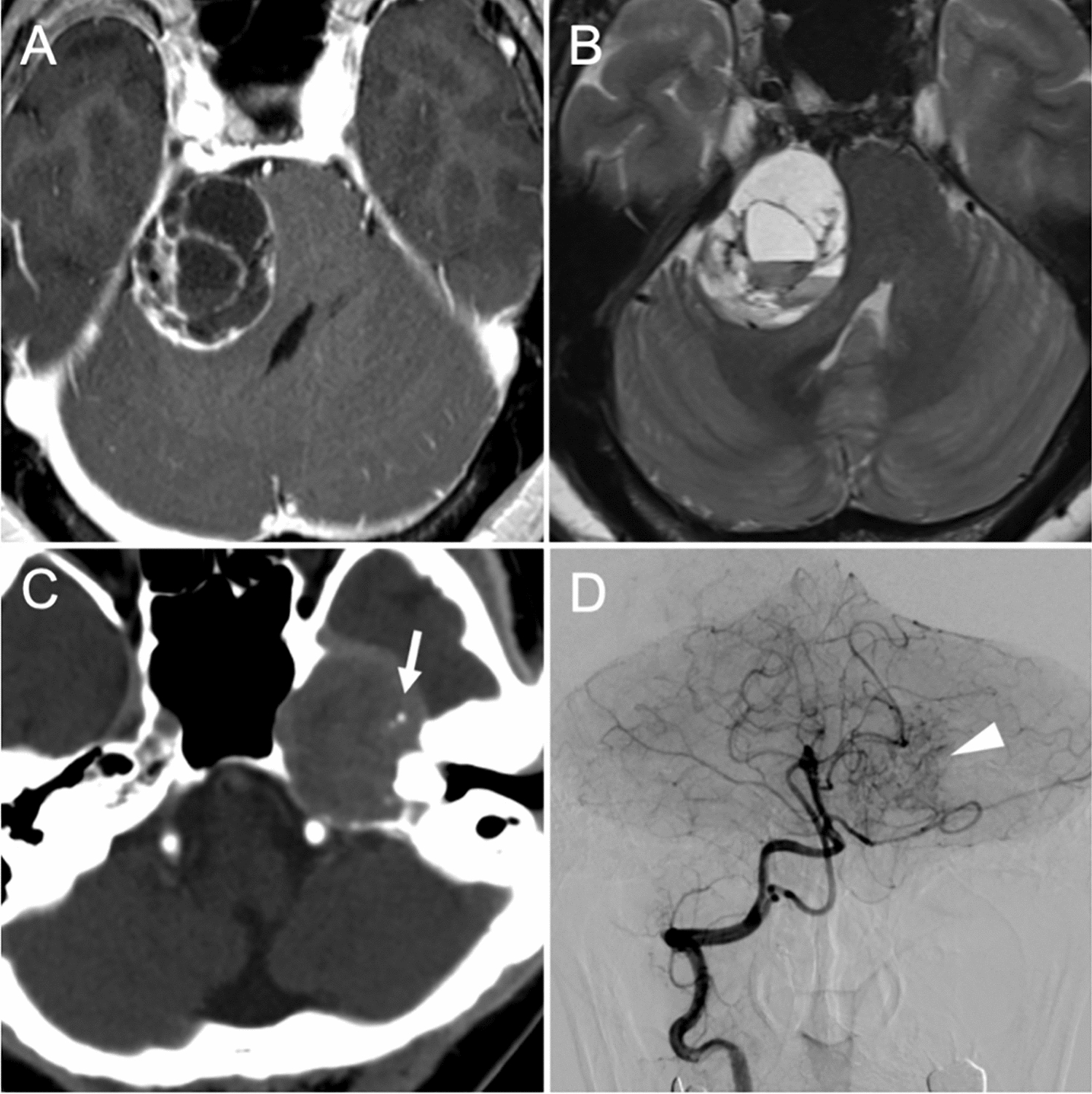 Clinical and radiological features of intracranial ancient schwannomas: a single-institution, retrospective analysis