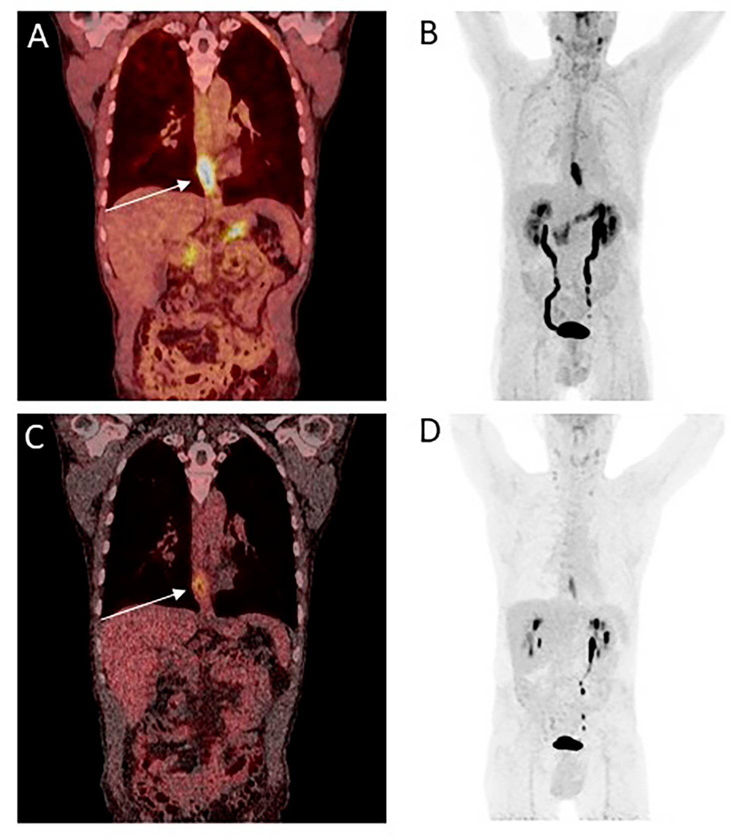 Impact of FAPI-46/dual-tracer PET/CT imaging on radiotherapeutic management in esophageal cancer