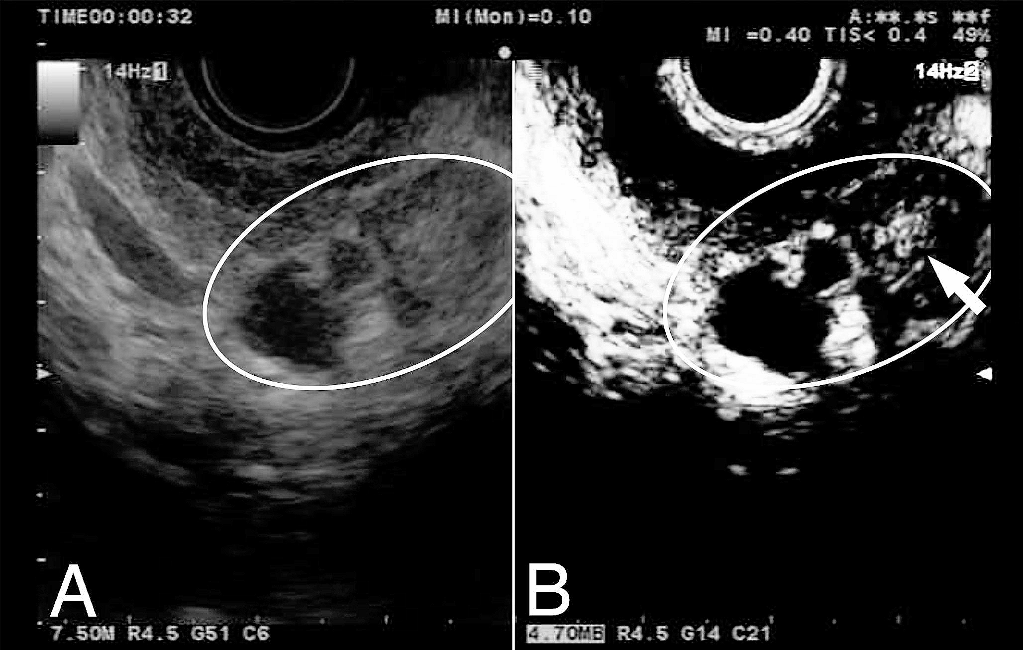 The role of endoscopic ultrasound in the detection of pancreatic lesions in high-risk individuals