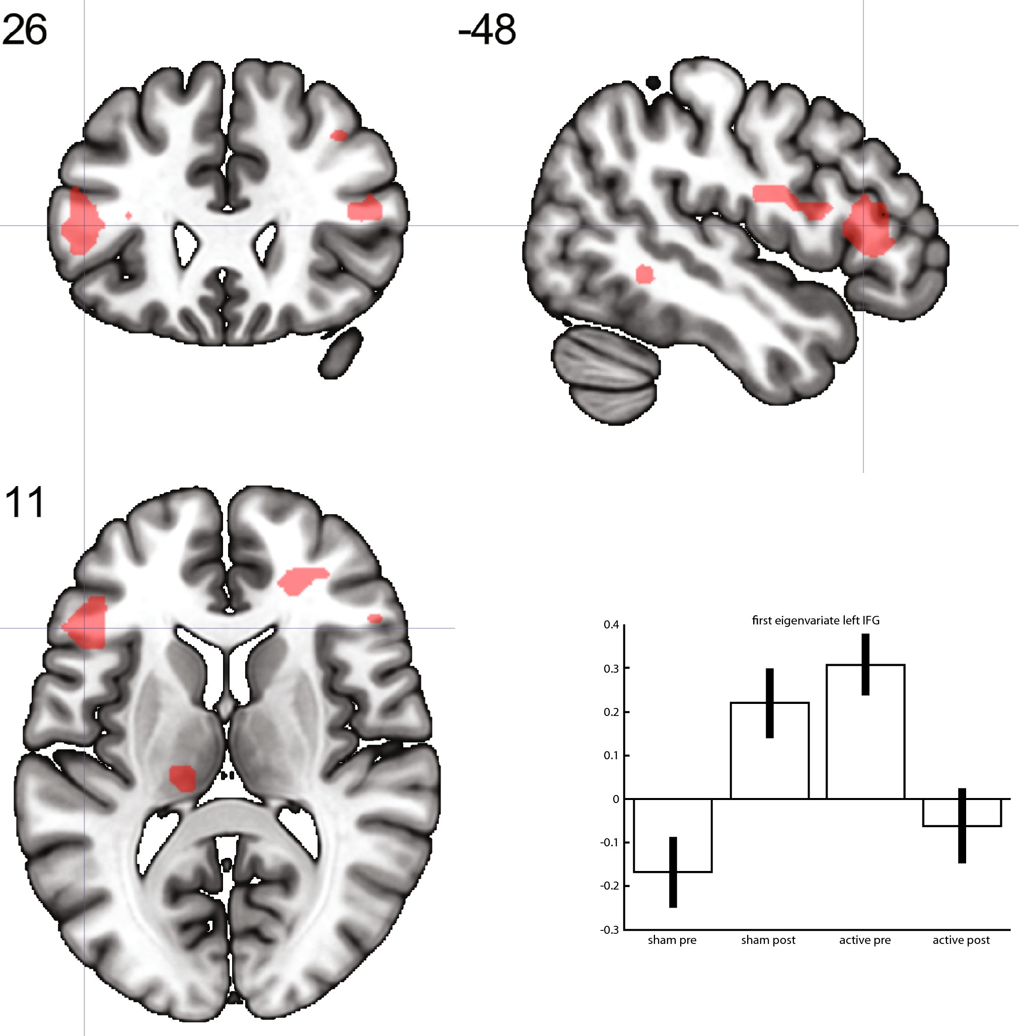 Change in brain activation after transcranial pulsed electromagnetic fields in treatment-resistant depression