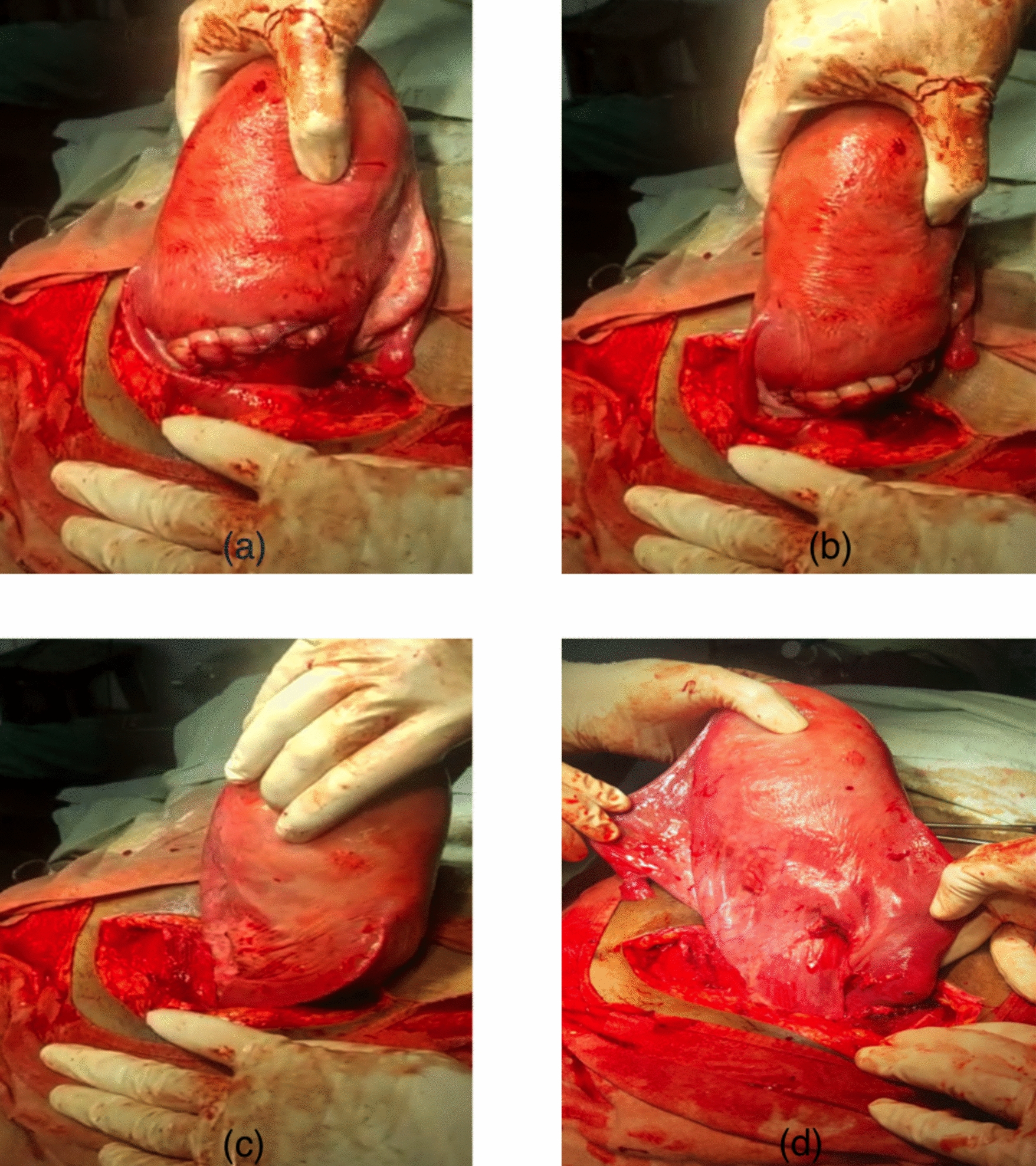 A Twist of Fate: Case Report of Complete Uterine Torsion at Term