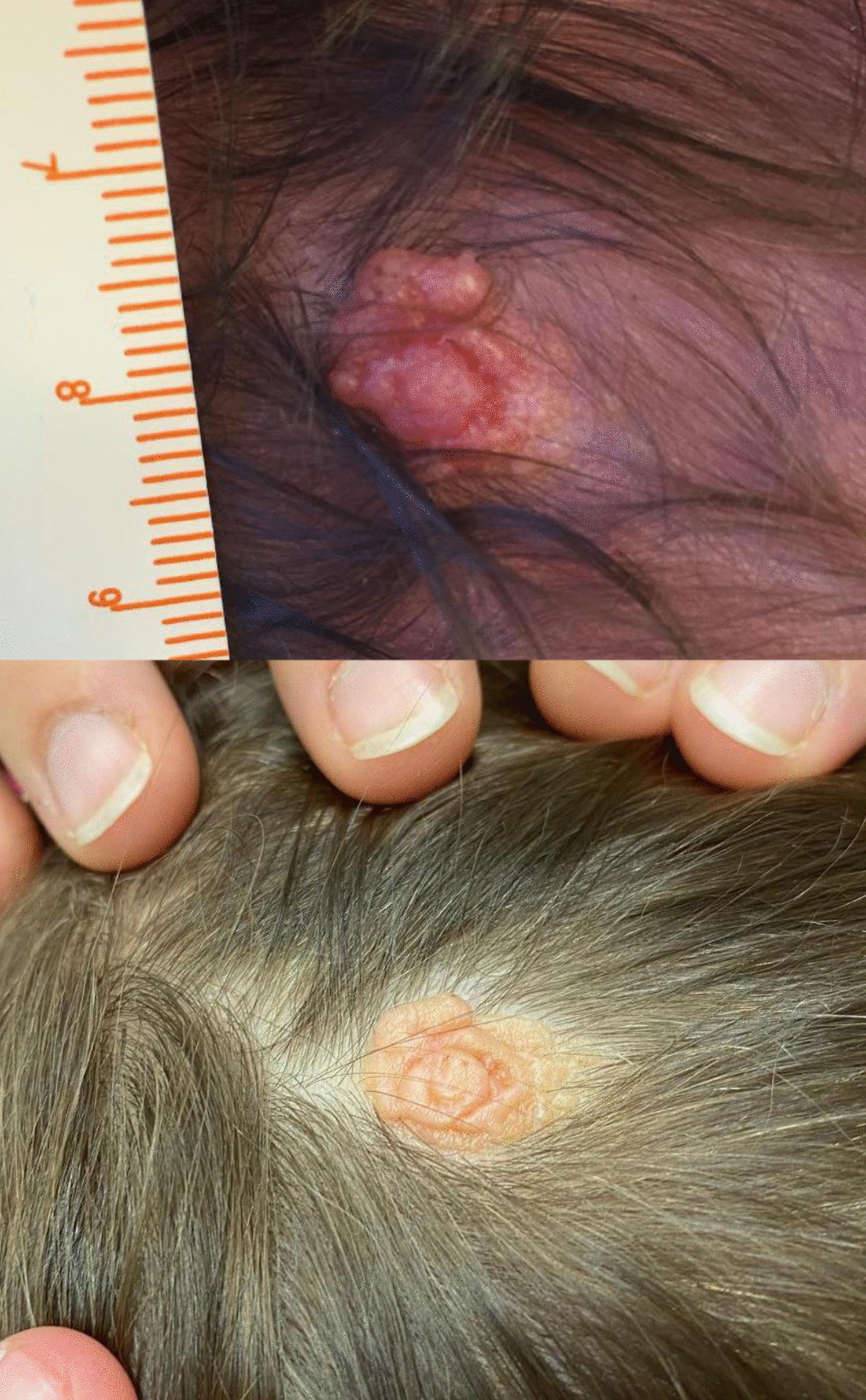 Nevus Sebaceous of Jadassohn’s Misdiagnosed as a Vascular Anomaly: a Pediatric Case Report
