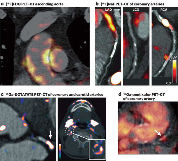 Uncovering atherosclerotic cardiovascular disease by PET imaging