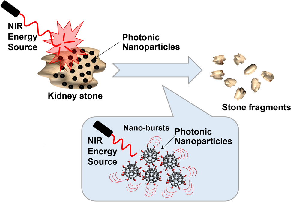 Proof-of-concept for a novel nanotechnology-based treatment for urolithiasis