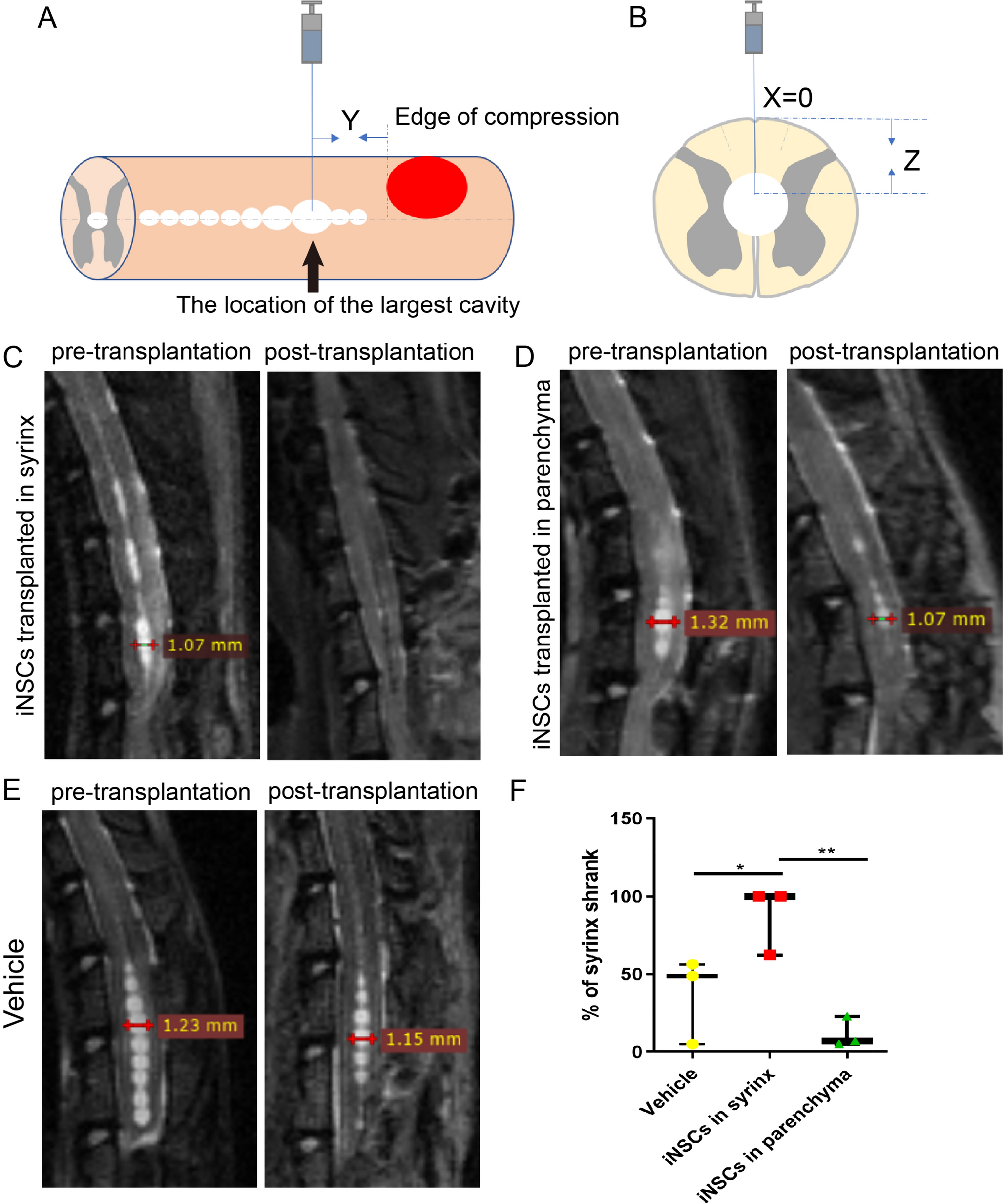 Treatment of Syringomyelia Characterized by Focal Dilatation of the Central Canal Using Mesenchymal Stem Cells and Neural Stem Cells