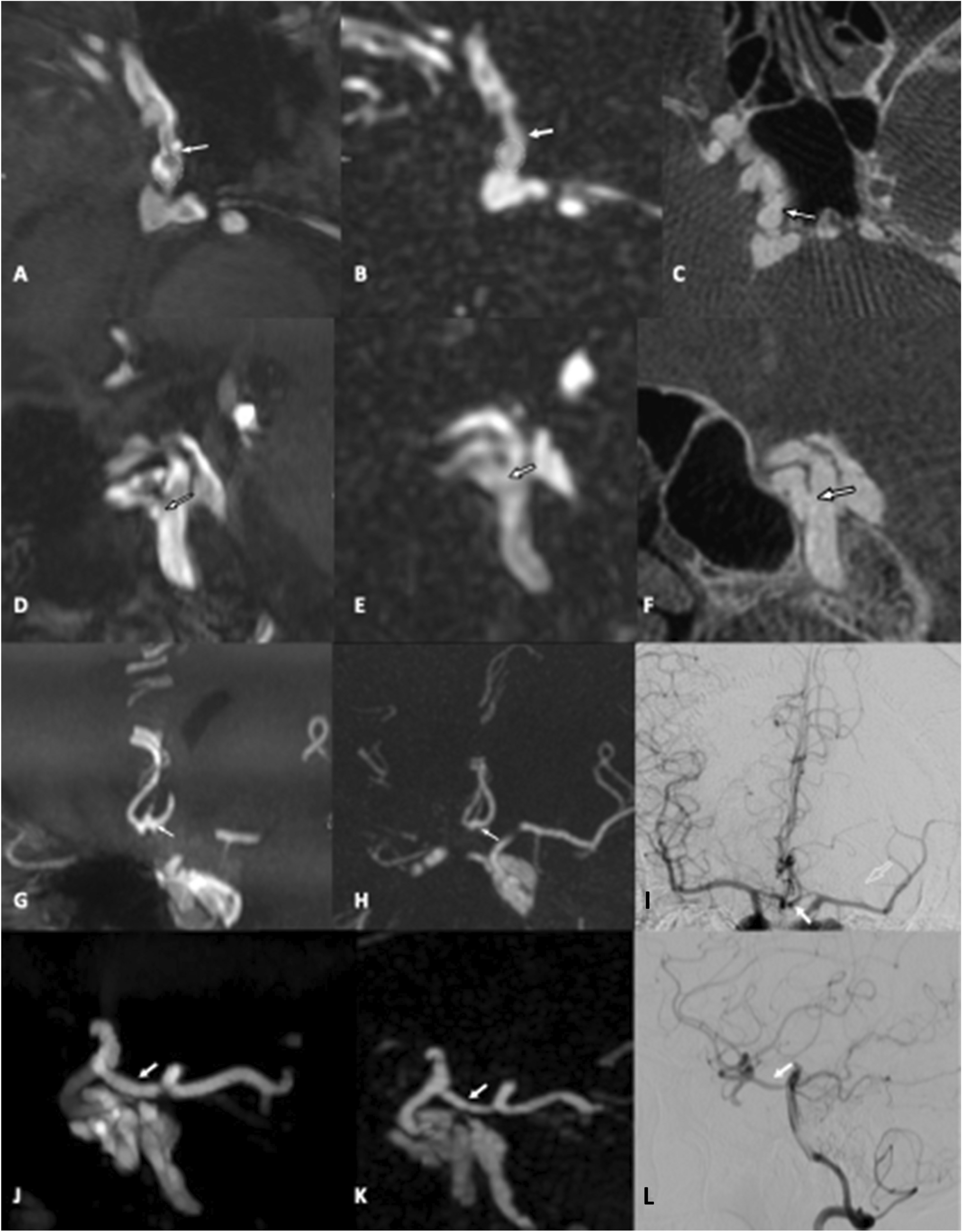 Evaluating the diagnostic performance of non-contrast magnetic resonance angiography sequences in the pre-procedural comprehensive analysis of direct carotid cavernous fistula