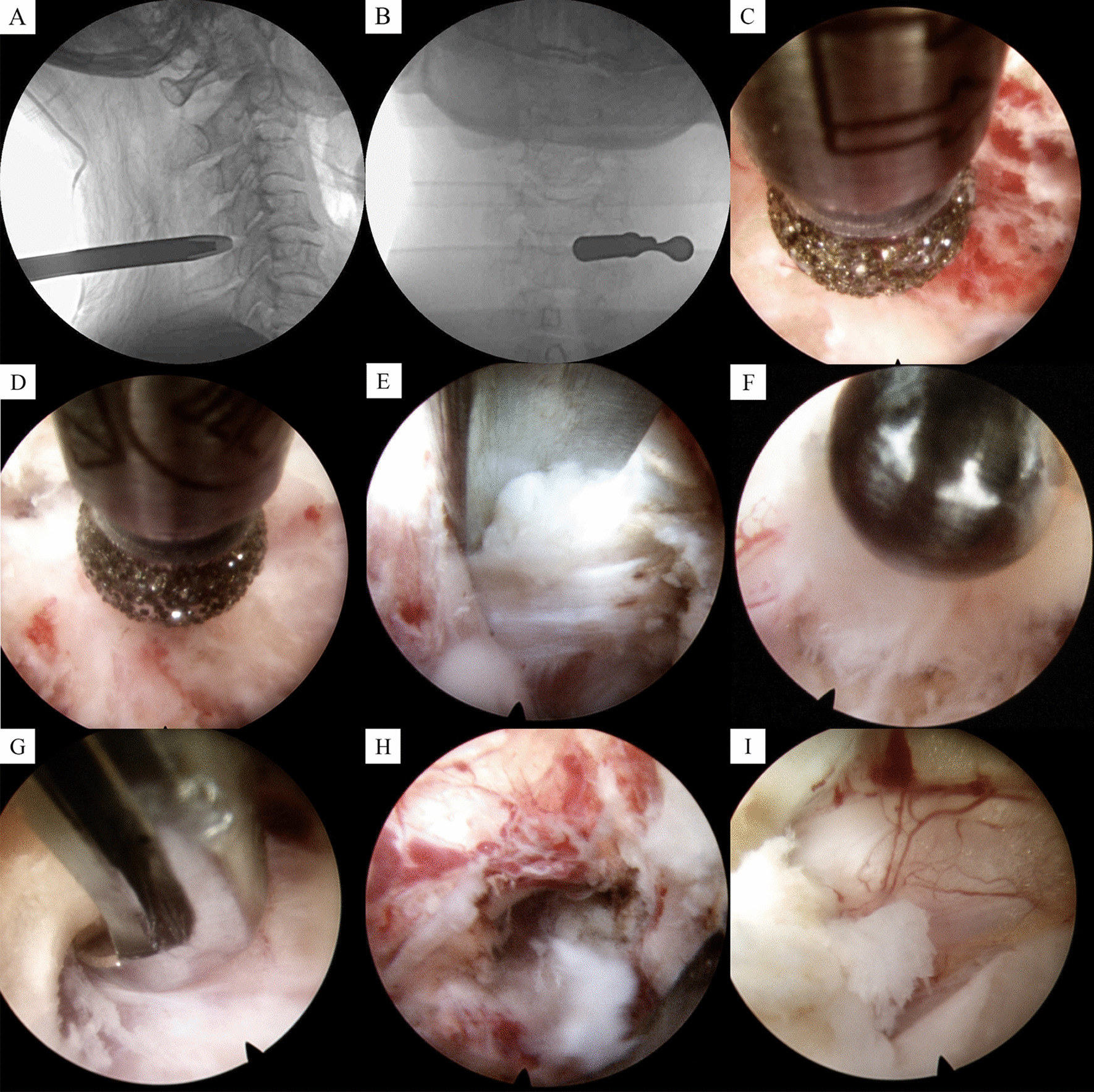 Full endoscopic laminotomy decompression versus anterior cervical discectomy and fusion for the treatment of single-segment cervical spinal stenosis: a retrospective, propensity score-matched study