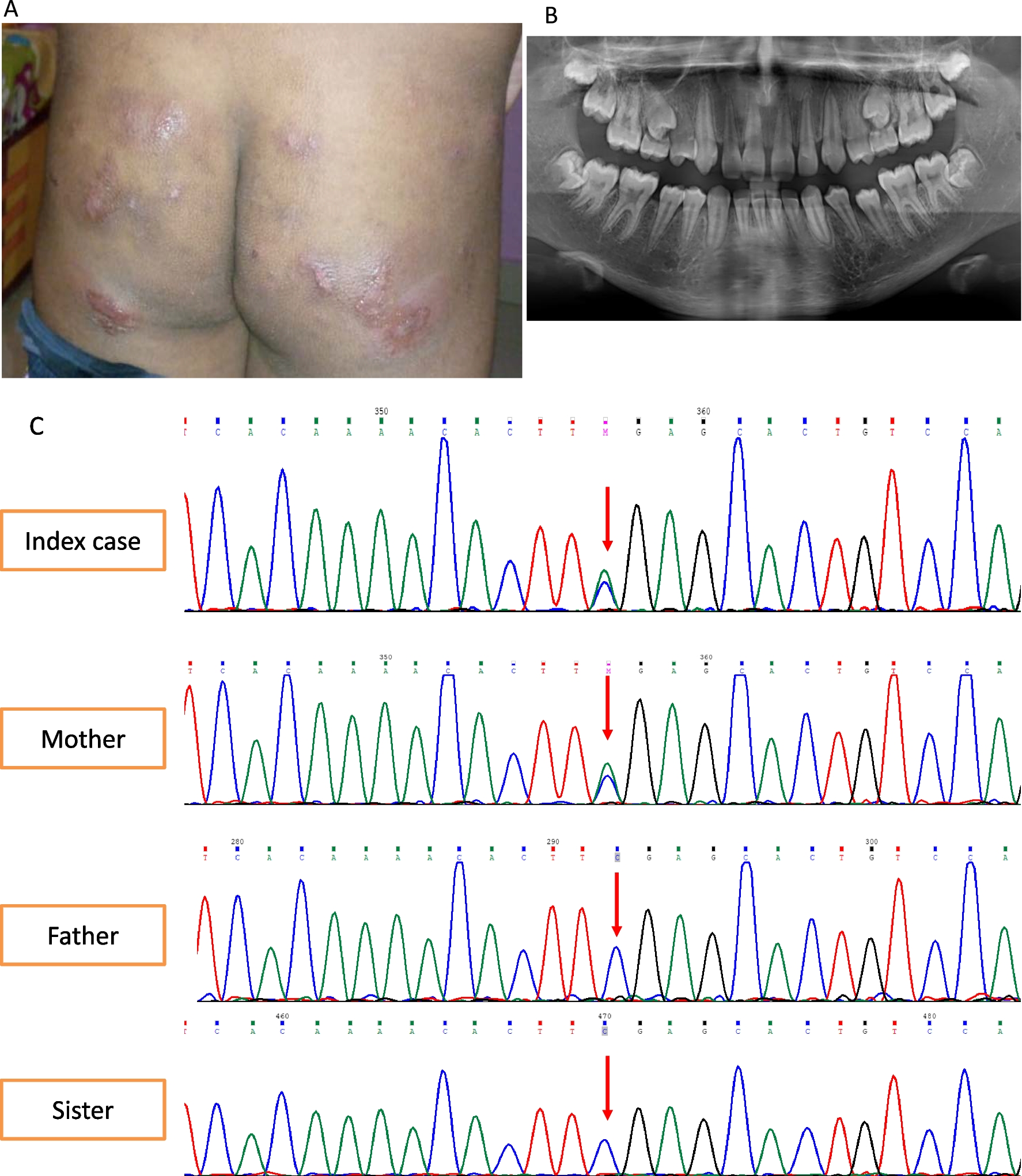 An Indian Family with Autosomal Dominant Hyper-IgE Syndrome Due to IL6ST Defect