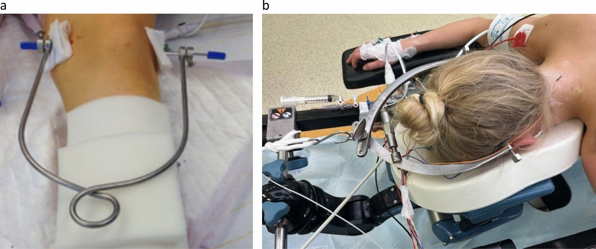 Risk factors for neurophysiological events related to intraoperative halo-femoral traction in spinal deformity surgery