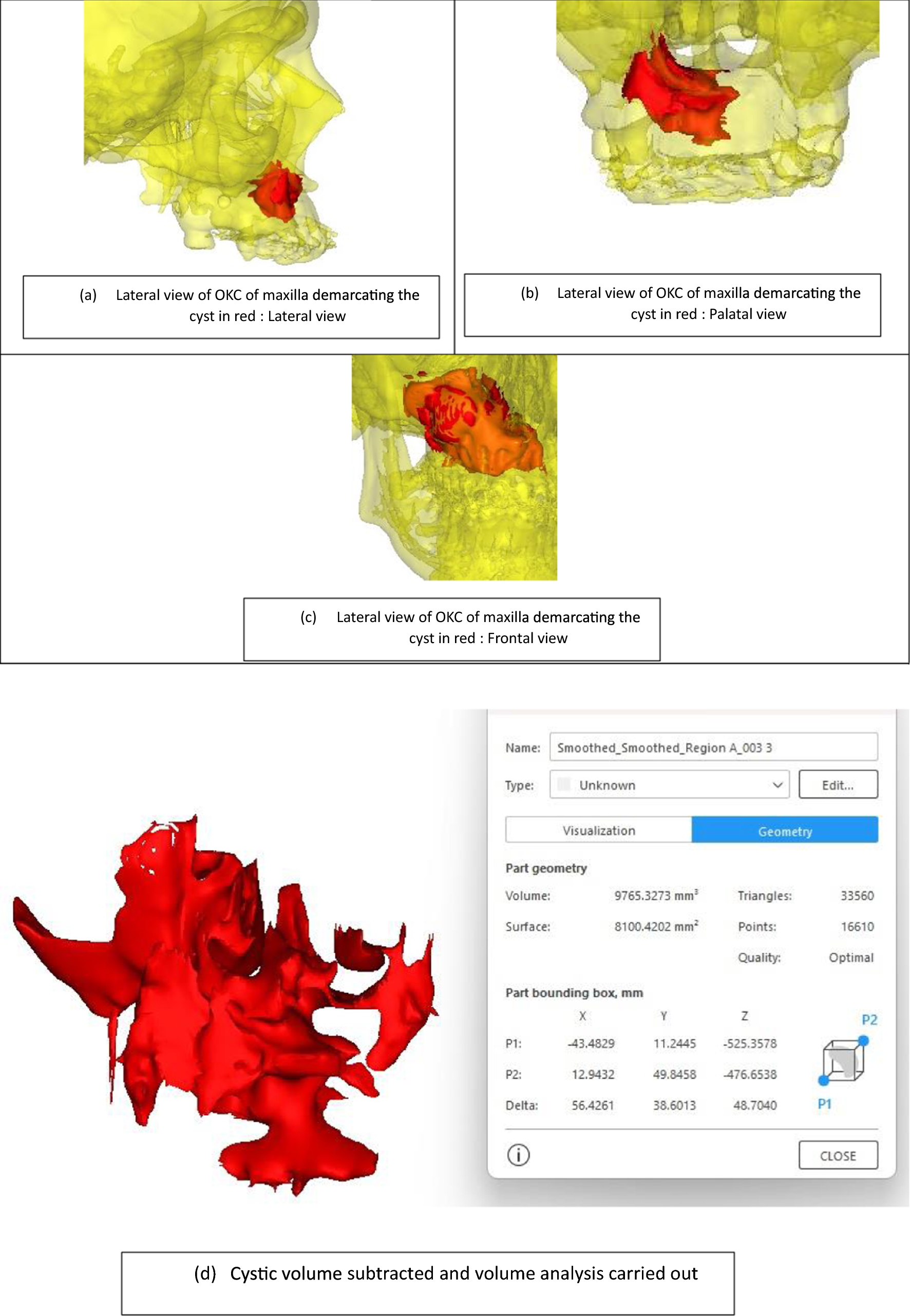 Volumetric Analysis and Healing Ratio: Refining Prognostic Assessment in Maxillofacial Cysts Using Cone-Beam Computed Tomography