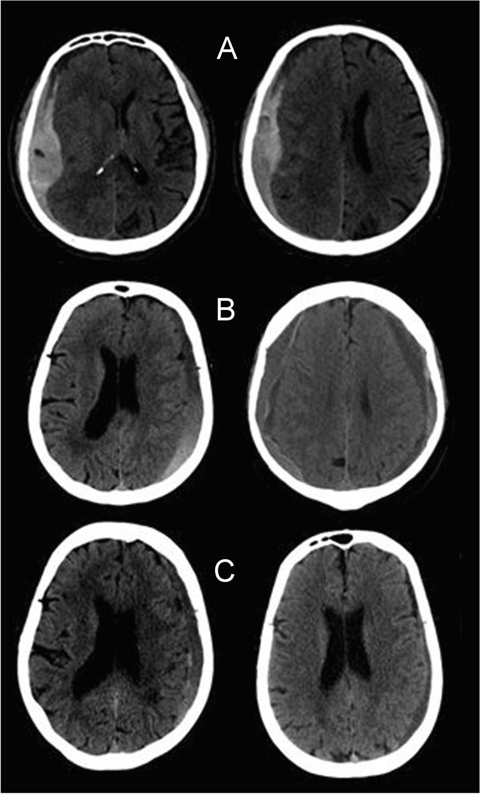 Establishment and validation of a CT-based prediction model for the good dissolution of mild chronic subdural hematoma with atorvastatin treatment