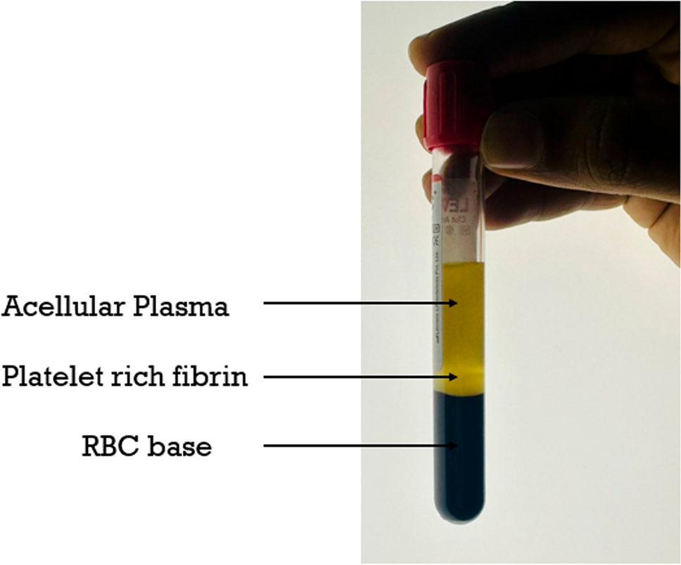 Advancement in Tympanic Membrane Repair: Exploring the Potential of Platelet Rich Fibrin