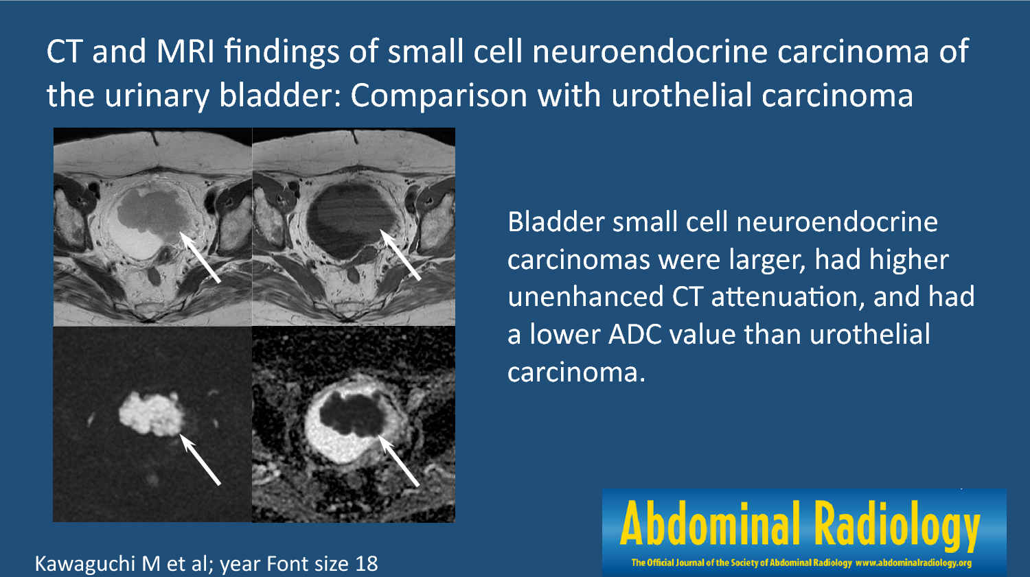 CT and MRI findings of small cell neuroendocrine carcinoma of the urinary bladder: comparison with urothelial carcinoma