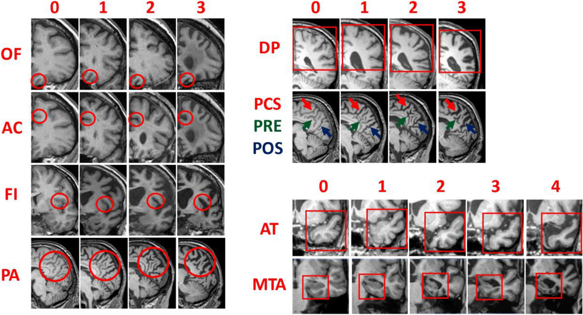 Utility of visual rating scales in primary progressive aphasia