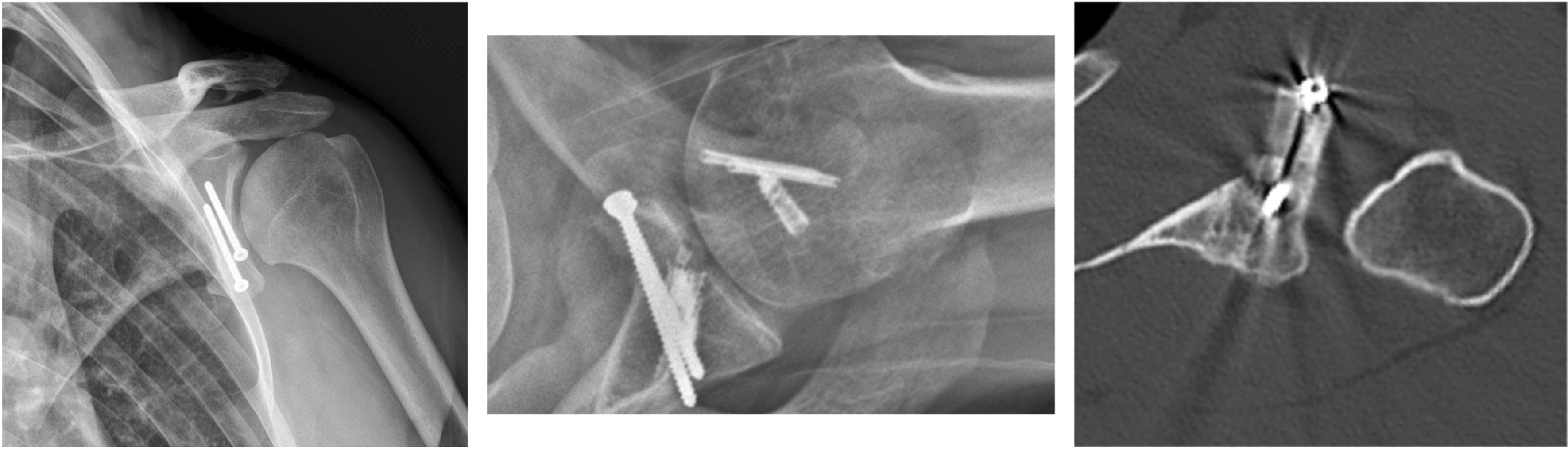 Sutures, Screws, Buttons, and Anchors: A Review of Current Bone Graft Fixation Devices for Glenoid Bone Loss in the Unstable Shoulder