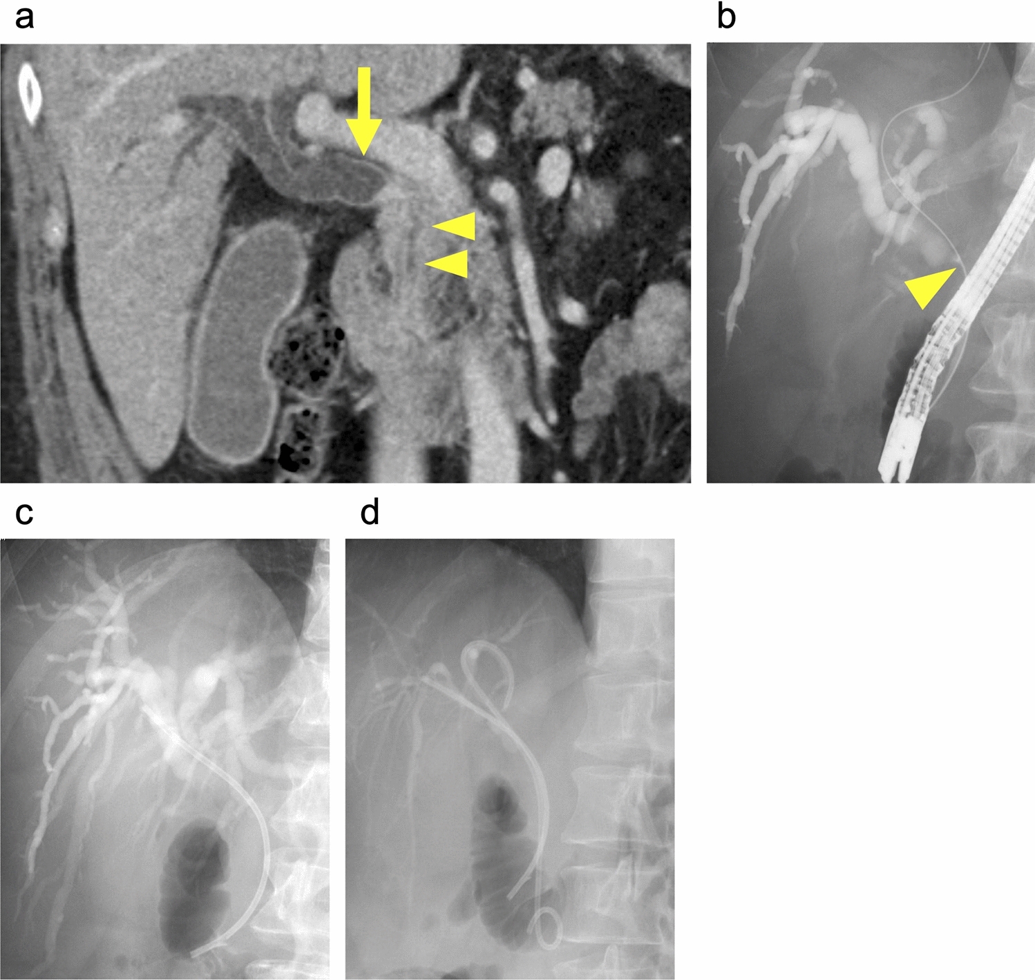 Pancreaticoduodenectomy after bilirubin adsorption for distal cholangiocarcinoma with severe obstructive jaundice refractory to repeat preoperative endoscopic biliary drainage: a case report