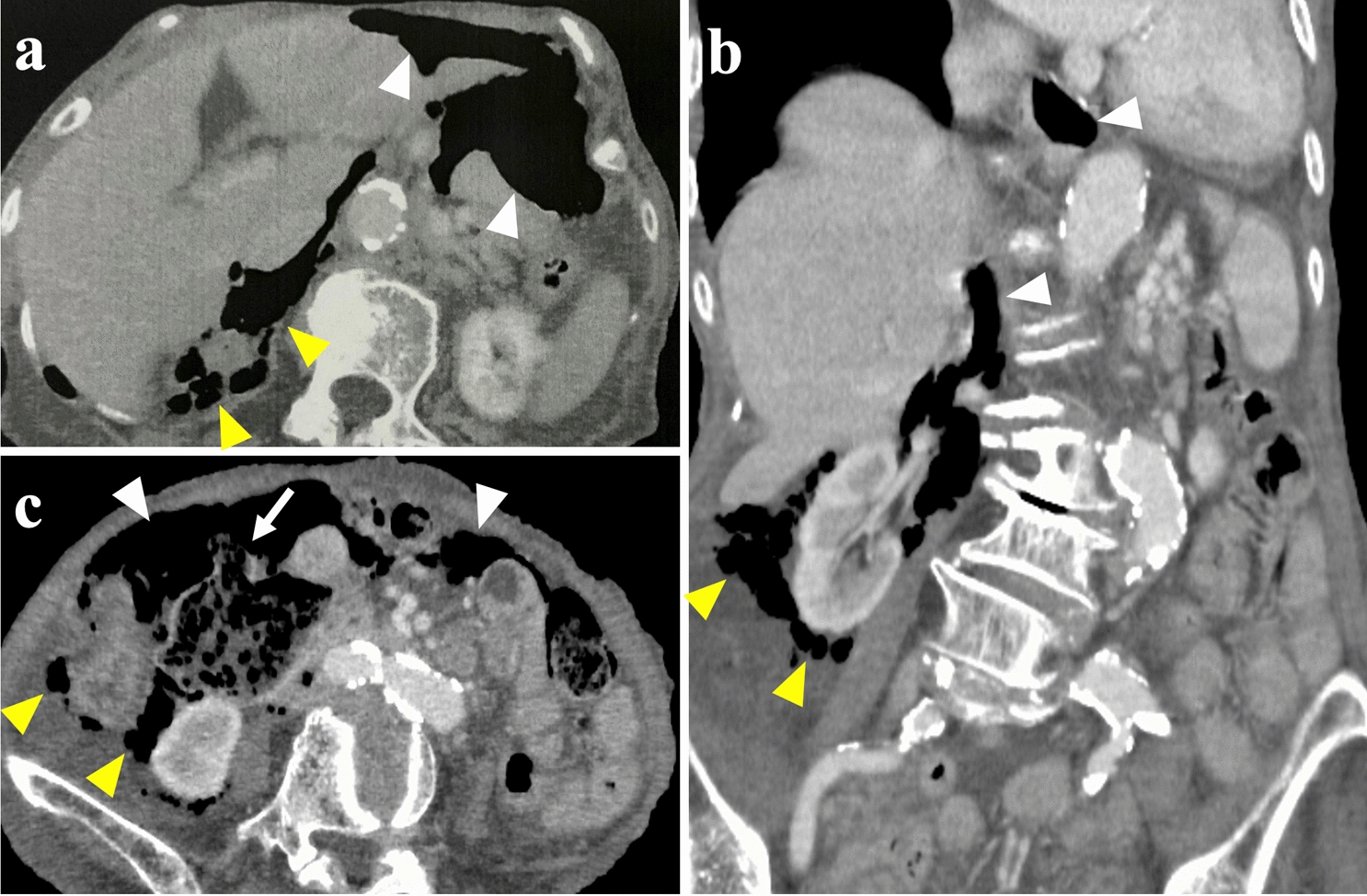 A perforation of a duodenal diverticulum in a 97-year-old patient after total gastrectomy and Roux-en-Y reconstruction: a case report