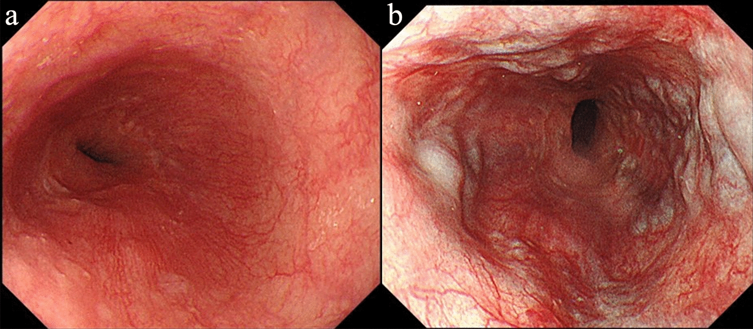 A case of recurrent follicular cholangitis leading to decompensated cirrhosis after left-sided hepatectomy