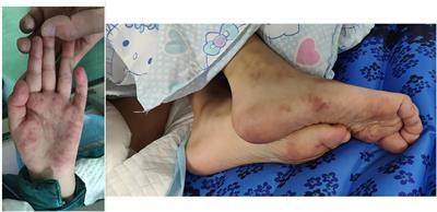 Primary catastrophic antiphospholipid syndrome in children with midbrain infarction: a case report