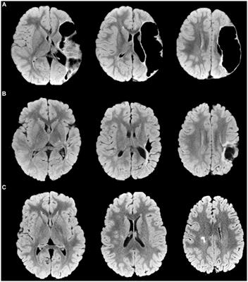 Neuroanatomical correlates of gross manual dexterity in children with unilateral spastic cerebral palsy