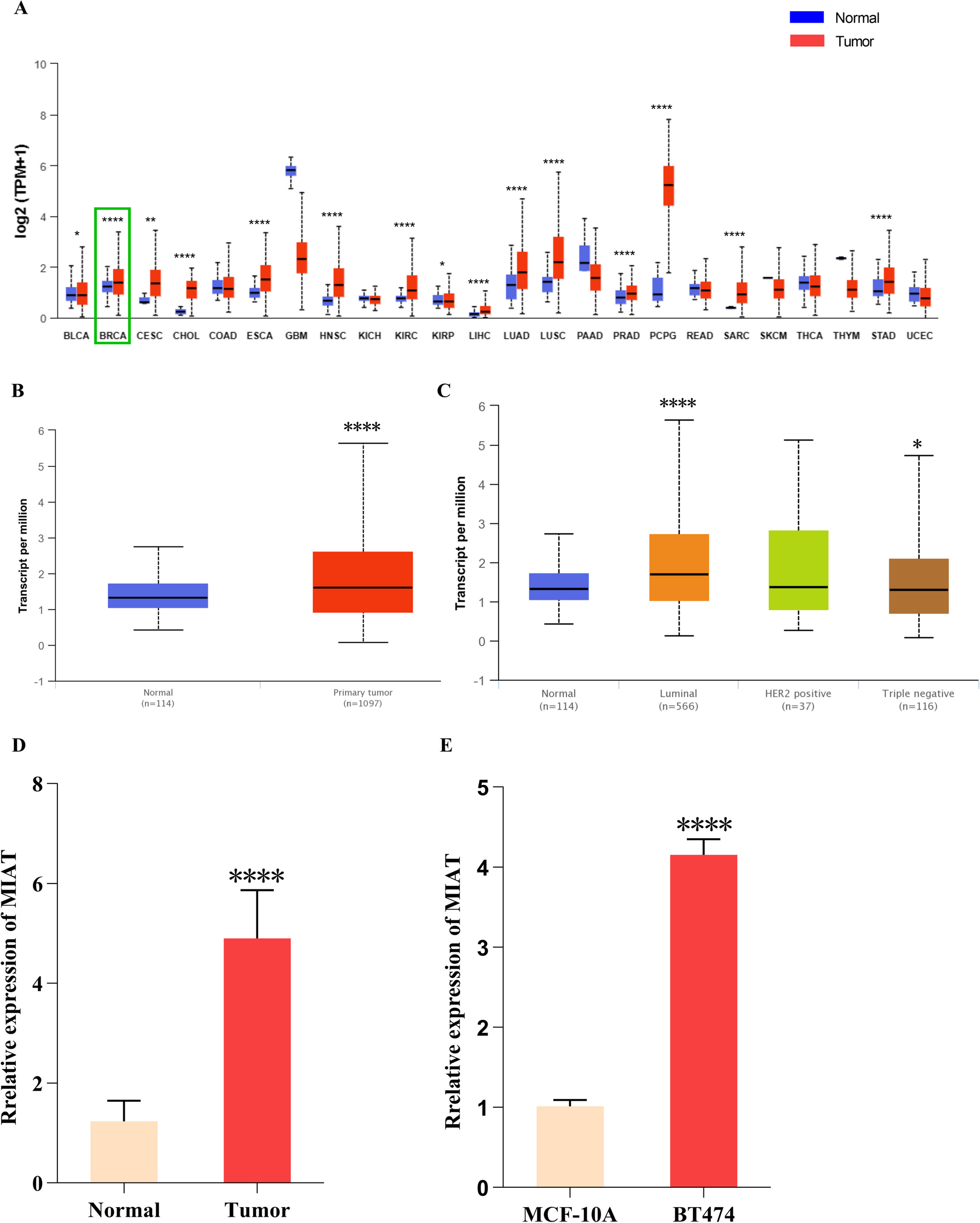 lncRNA MIAT promotes luminal B breast cancer cell proliferation, migration, and invasion in vitro