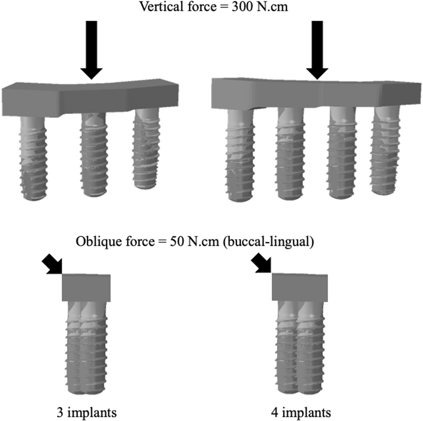 The Influence of Implant Number on Stress Distribution in the Anterior Region of Mandible Reconstructed with Fibula Bone Graft: A Finite Element Analysis