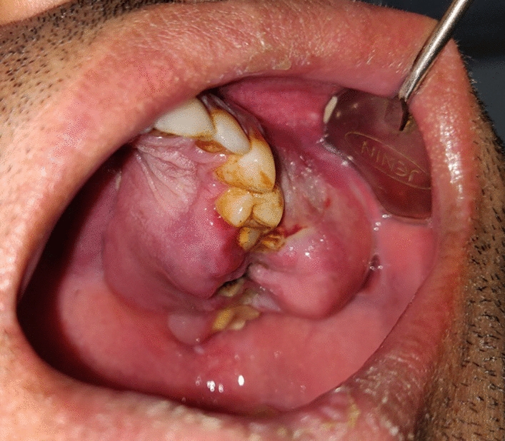 Management Modalities of Aggressive Brown Tumor of the Jaws—a Case Series