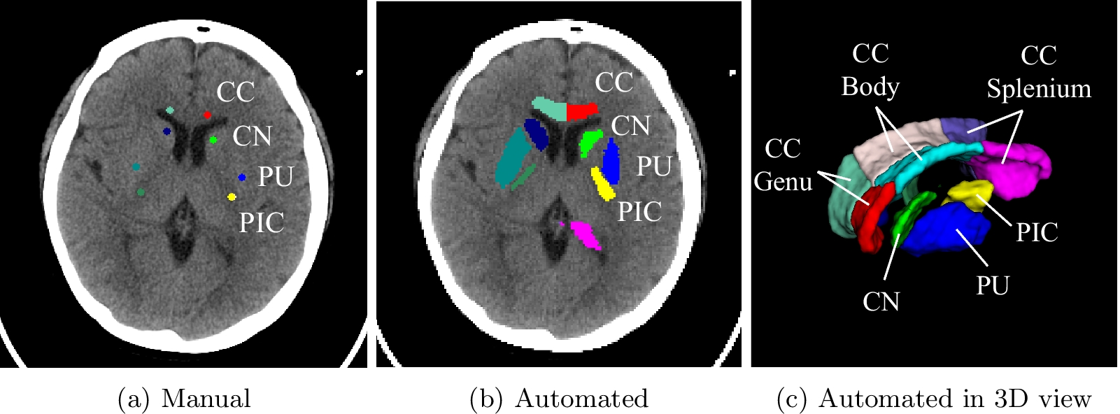 Outcome prediction of cardiac arrest with automatically computed gray-white matter ratio on computed tomography images