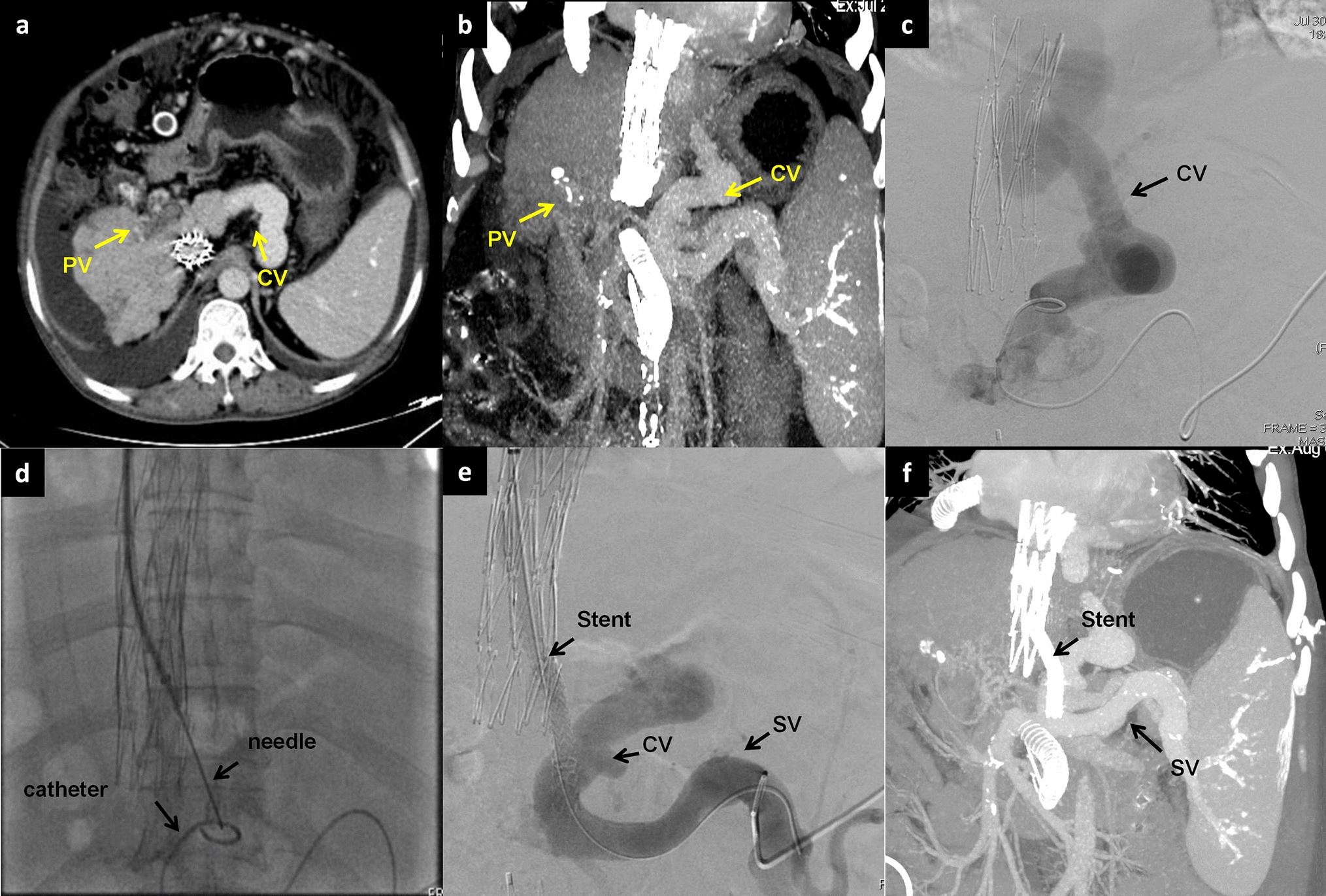 Efficacy and safety of precision-guided transjugular extrahepatic portosystemic shunt (TEPS) in the management of cavernous transformation of the portal vein with portal hypertension: a case series