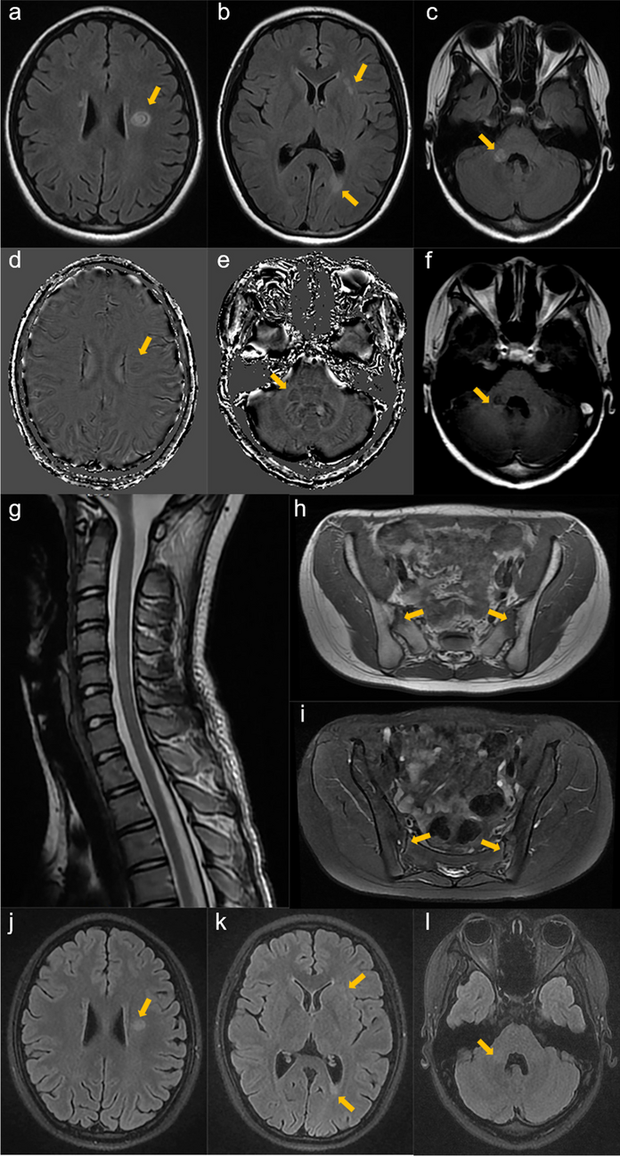 Multiple sclerosis associated with adalimumab use in ankylosing spondylitis