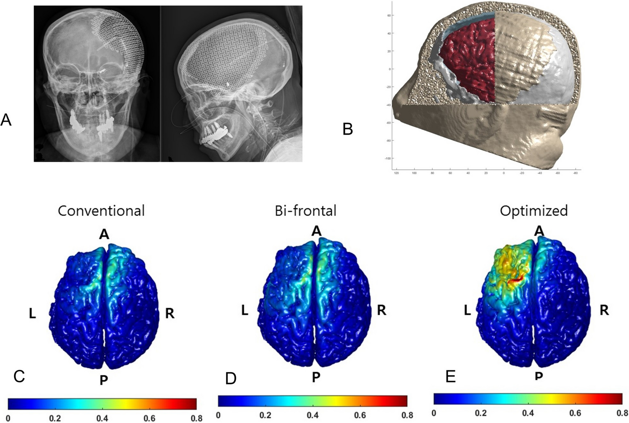 Optimized trans-cranial direct current stimulation for prolonged consciousness disorder in a patient with titanium mesh cranioplasty