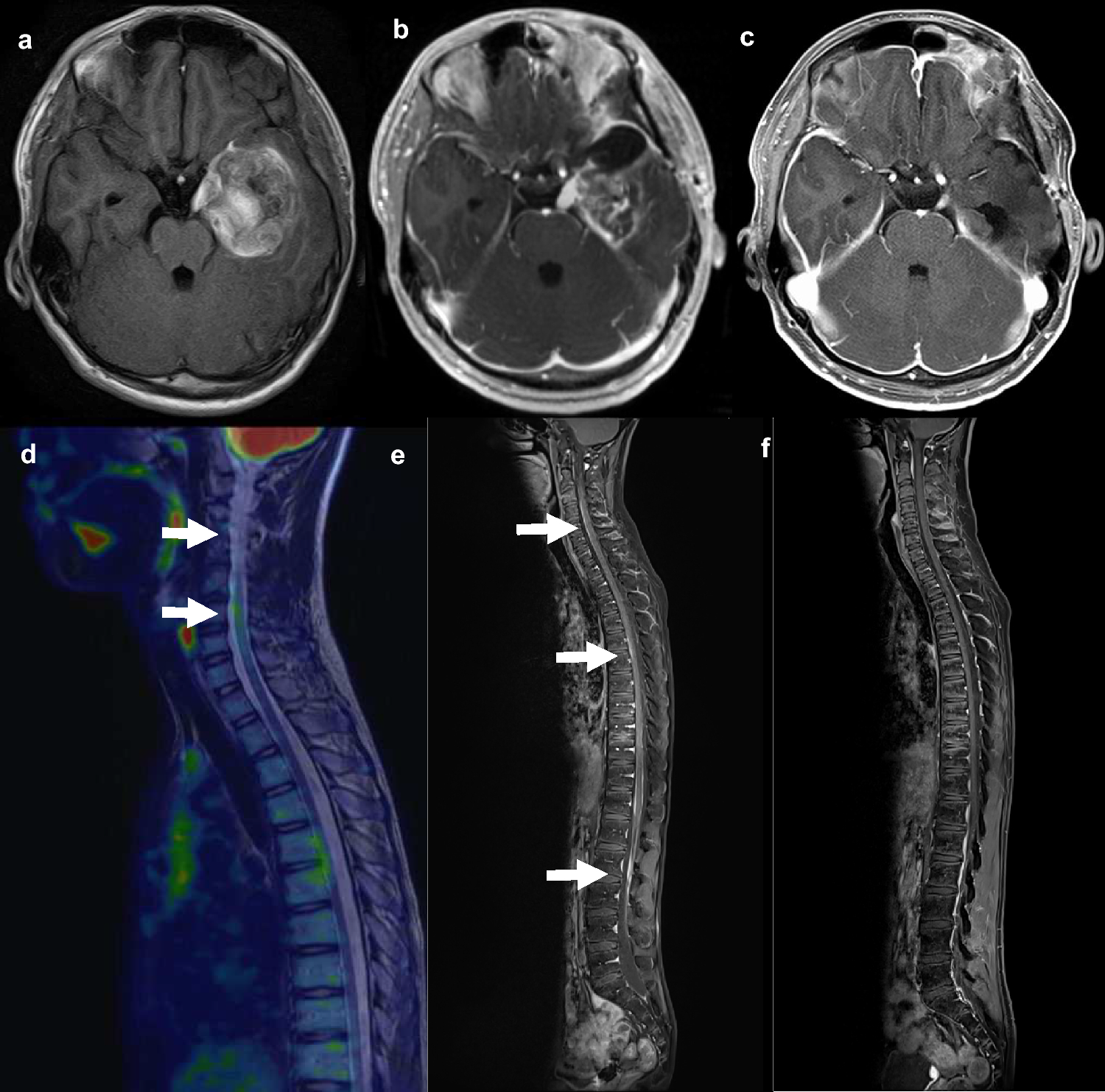 Successful treatment of pediatric patients with high-grade gliomas featuring leptomeningeal metastases by targeting BRAF V600E mutations with dabrafenib plus trametinib: two illustrative cases