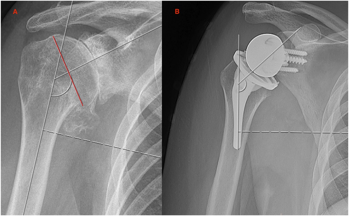 The Influence of Component Design and Positioning on Soft-Tissue Tensioning and Complications in Reverse Total Shoulder Arthroplasty: A Review