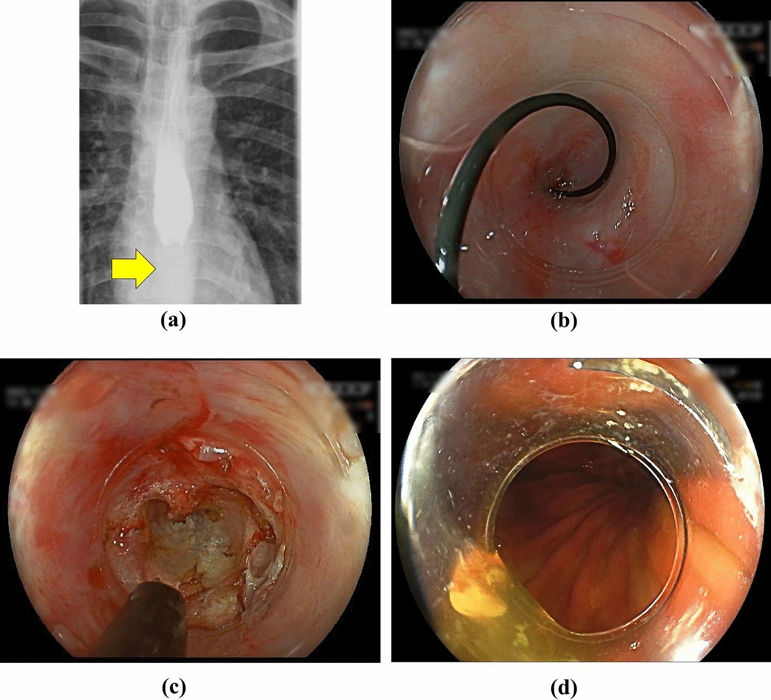 Endoscopic Longitudinal Incision and Recanalization in the Treatment of Acquired Esophageal Atresia (with Video)