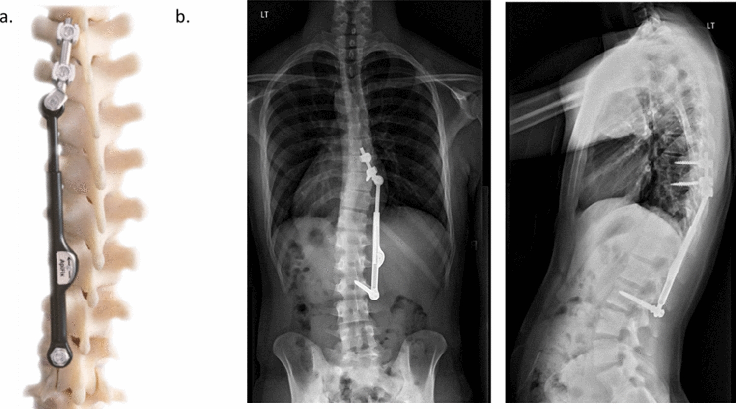 Tissue response following implantation with the posterior dynamic distraction device (PDDD) in adolescent idiopathic scoliosis (AIS)