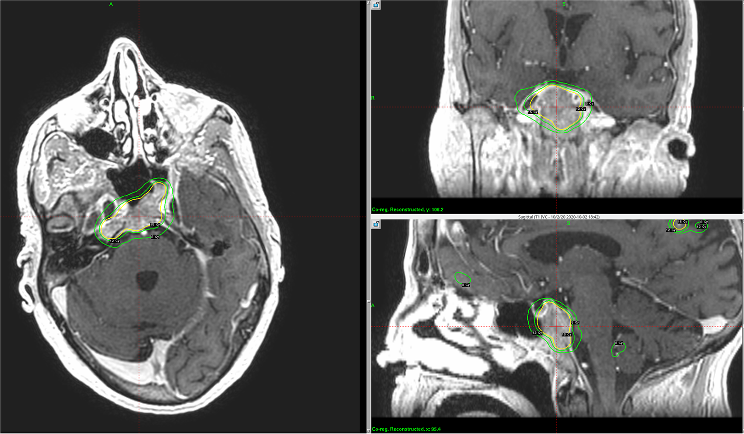Gamma knife radiosurgery for clival metastasis: case series and systematic review