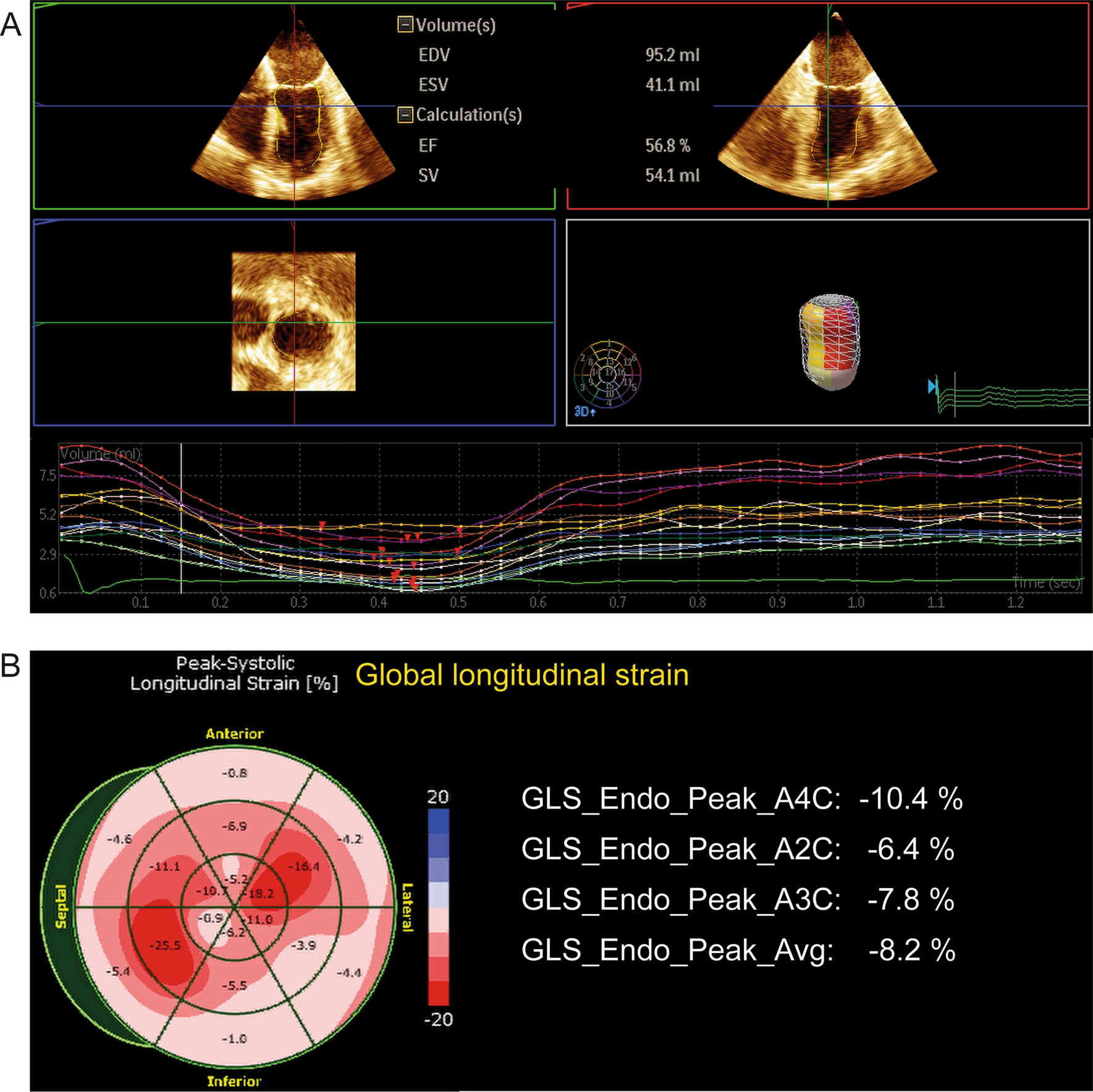 Perioperative echocardiographic strain analysis: what anesthesiologists should know